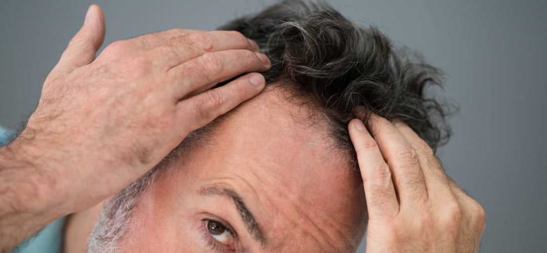 Exceso de grasa y caída del pelo